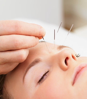 Soothing acupuncture therapy